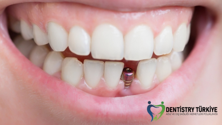 Dental implant bakımının temelleri: Tek diş replasmanı