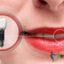 “Diş İmplantları: Modern Ağız ve Diş Sağlığının İlerleyen Yüzü”